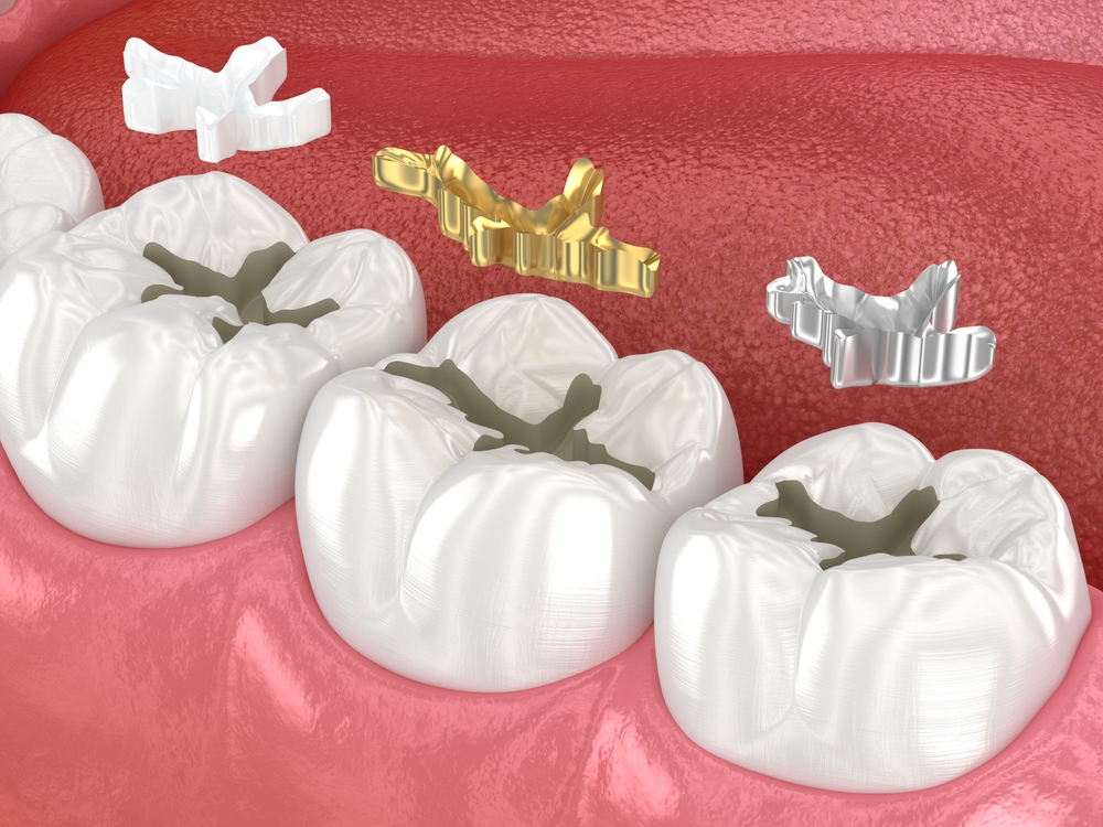 Dental Filling Treatment in Kondapur